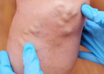 Trombosis venosa es la tercera causa de muerte a nivel mundial