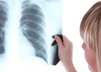 Muertes por tuberculosis se incrementaron en el planeta por primera vez en 10 años