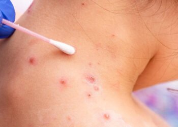 Portugal y España se unen a Reino Unido tras registrar casos de viruela del mono