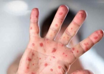 La OMS anticipa que aparecerán más casos de la viruela del mono