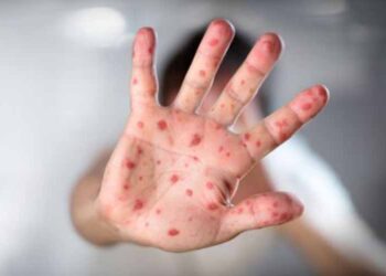 Confirmaron primeros casos de viruela del mono en Latinoamerica