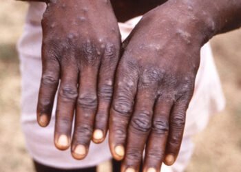 Chile confirmó detección del primer caso de viruela del mono en el país