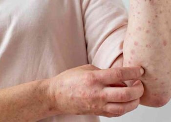 Perú confirmó primer caso de viruela del mono