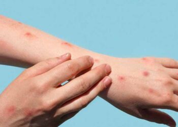 El brote de viruela del mono en países no endémicos supera los 2.000 casos