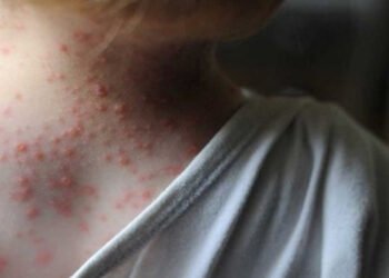 OMS convocó la comisión de emergencias para tratar sobre la viruela del mono