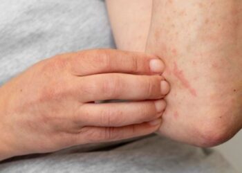 La dermatitis atópica afecta la calidad de vida de las personas