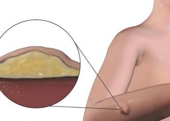 Los lipomas pueden causar limitaciones funcionales en las personas