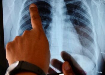 ONG: 46 trabajadores sanitarios contrajeron tuberculosis en 2022