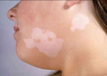 Existen múltiples tratamientos para las manchas en la piel