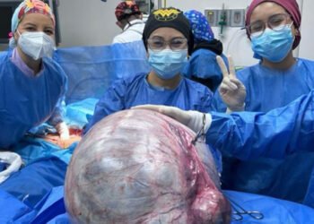 Extraen tumor de 25,5 kilos en el Hospital Razetti de Barcelona